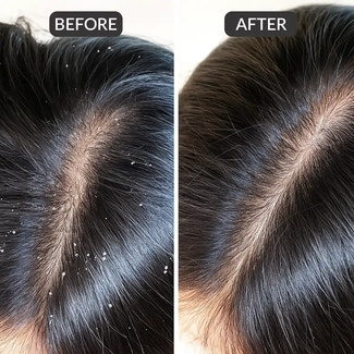 ScalpSense Dandruff Defense Vaccine