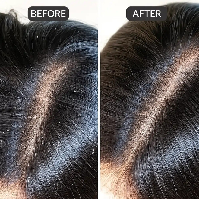 ScalpSense Dandruff Defense Vaccine
