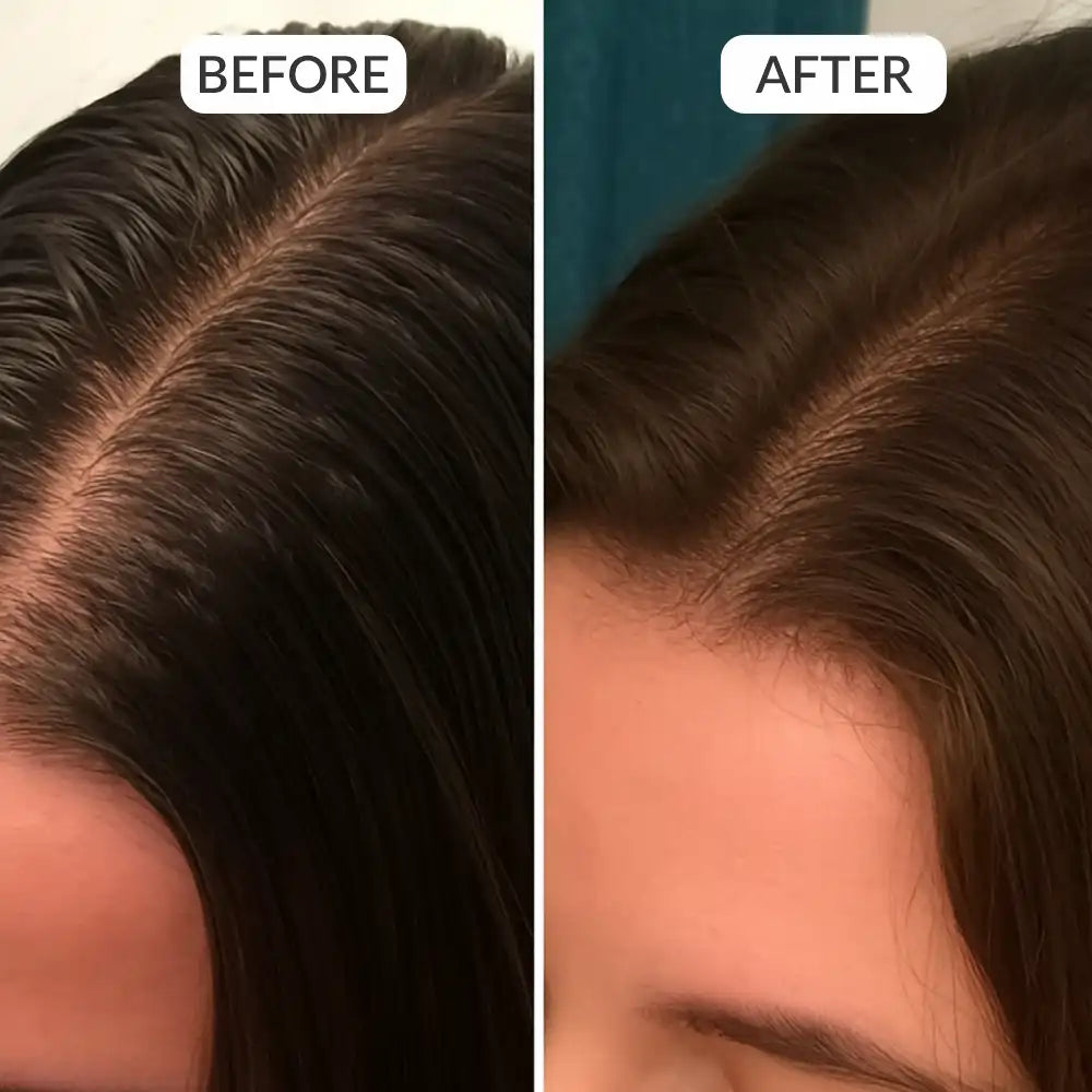 ScalpSense Oil Out Vaccine