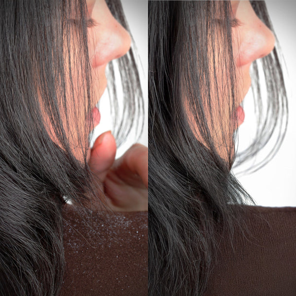 Close-up of a woman's side profile before and after using ScalpSense Dandruff Defense Shampoo.