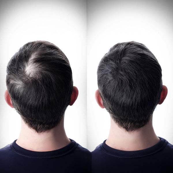 Before and after images showcase the remarkable transformation of a man's scalp, thanks to ScalpSense Leave-In Treatment.